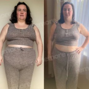 Gastric sleeve surgery (Sleeve gastrectomy) - photo 3