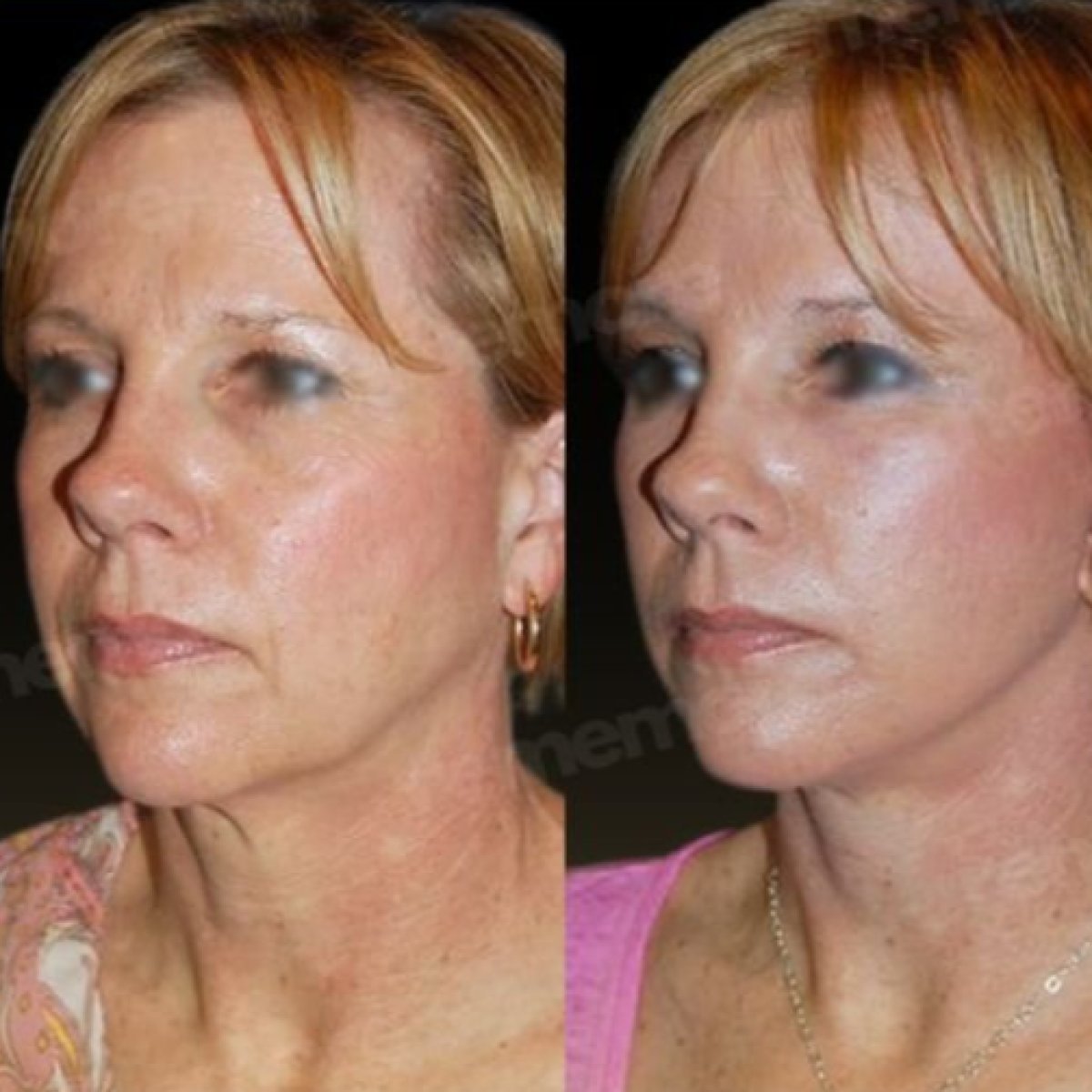 Vorher-nachher-Ergebnisse Facelift bei Memorial Ankara Hospital, sichtbare Verjüngung