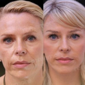 Facelift - photo 2