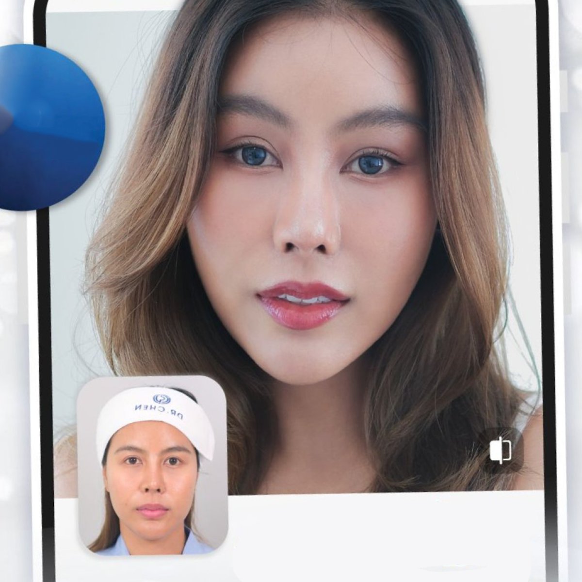 Resultado de minilifting facial antes y después en Dr. Chen Surgery Hospital International Center, rejuvenecimiento