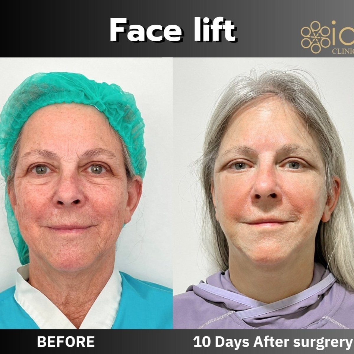 Resultados de lifting facial antes y después en ID Clinic Bangkok, rejuvenecimiento en 10 días