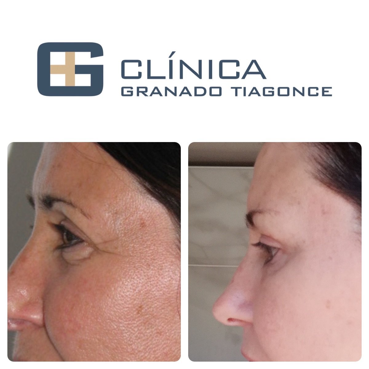 Résultats avant/après chirurgie des paupières supérieures à Clinica Granado Tiagonce, yeux rajeunis