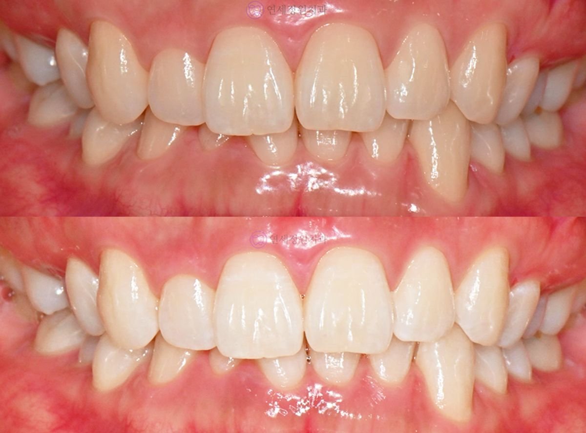 Vorher-nachher-Ergebnis Zahnaufhellung bei Yonsei JW Dental Clinic, sichtbar helleres Lächeln