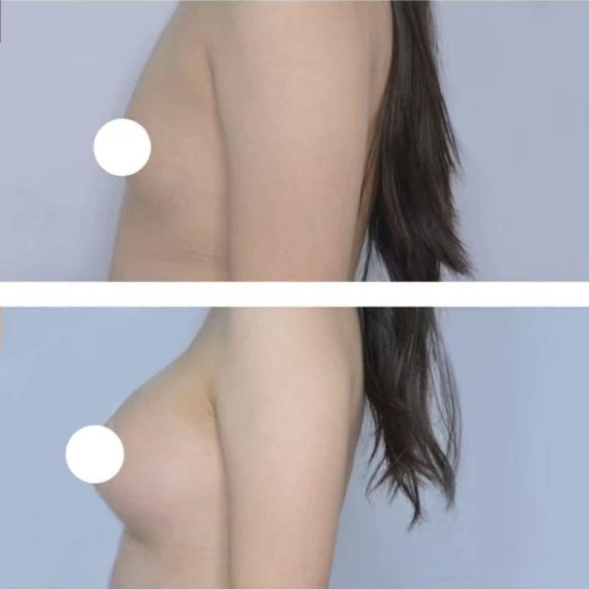 Résultats avant/après augmentation mammaire à la Kongju Clinic, volume des seins accru