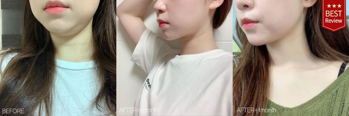 Before and after lipofilling at Bbae Clinic – enhanced chin and jawline contour result