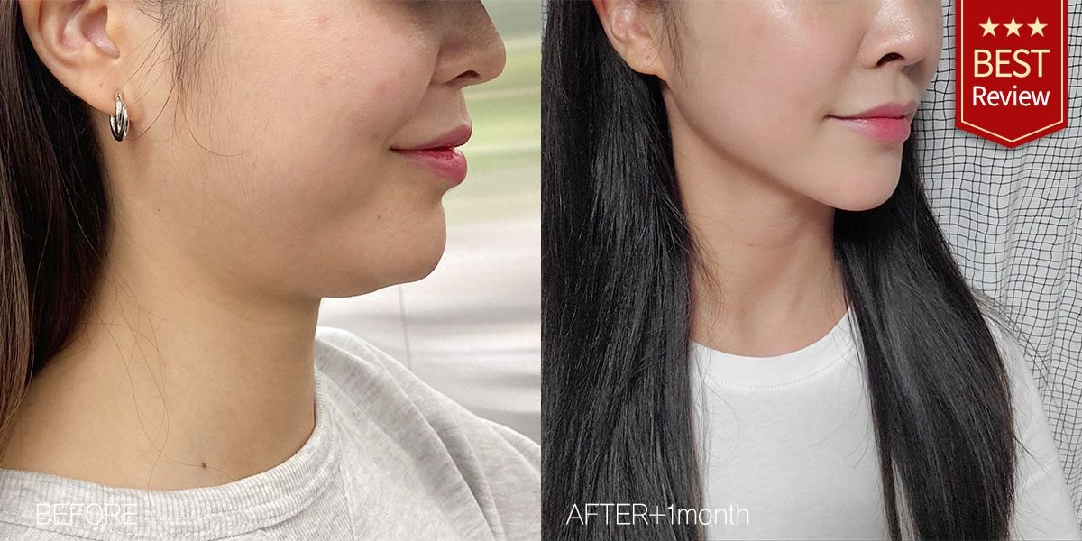 Before and after lipofilling at Bbae Clinic – enhanced jawline contour result after 1 month