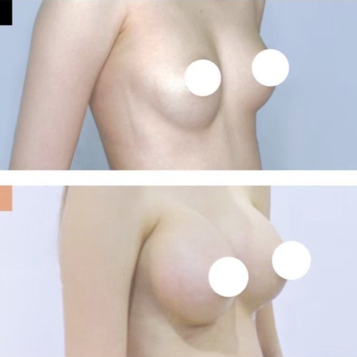 Before and after breast augmentation results at Kongju Clinic, enhanced breast volume