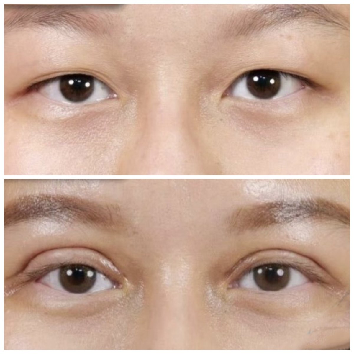 Resultados antes y después de cirugía de doble párpado en Kongju Clinic, pliegue mejorado