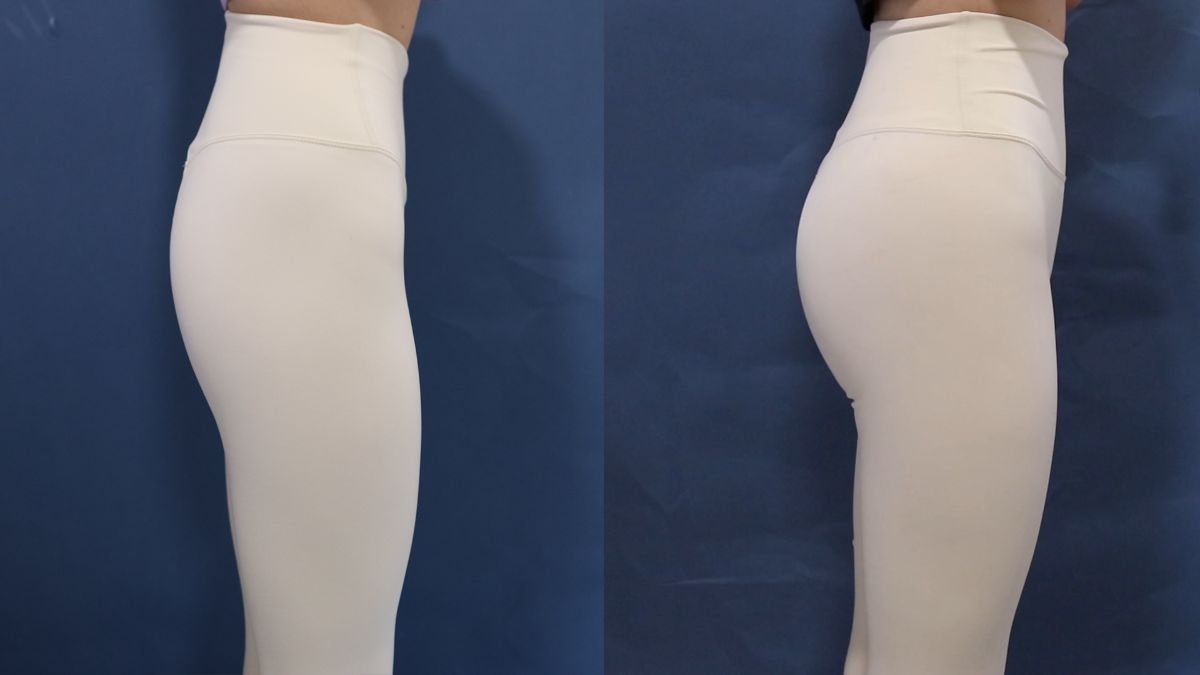 Résultats avant et après lifting des fesses chez HERSHE Plastic Surgery Korea, contour amélioré