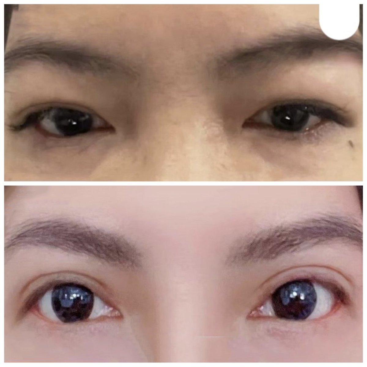 Resultados antes y después de cirugía de doble párpado en Kongju Clinic, ojos realzados