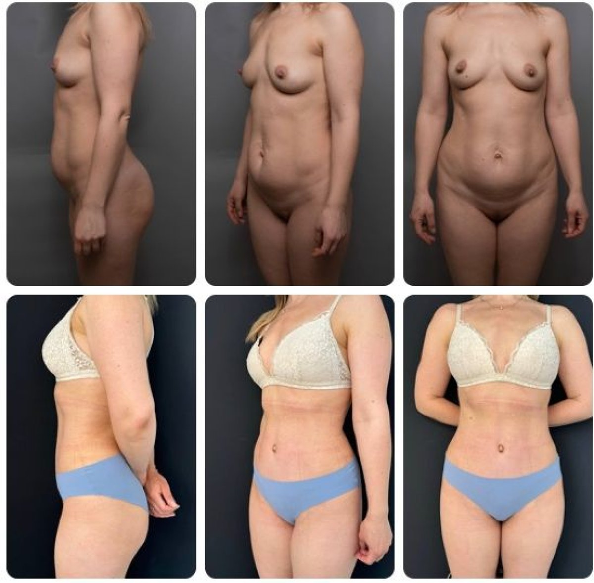 Before and after tummy tuck and liposuction results at Yurchenko Plastic Surgery Team Kyiv