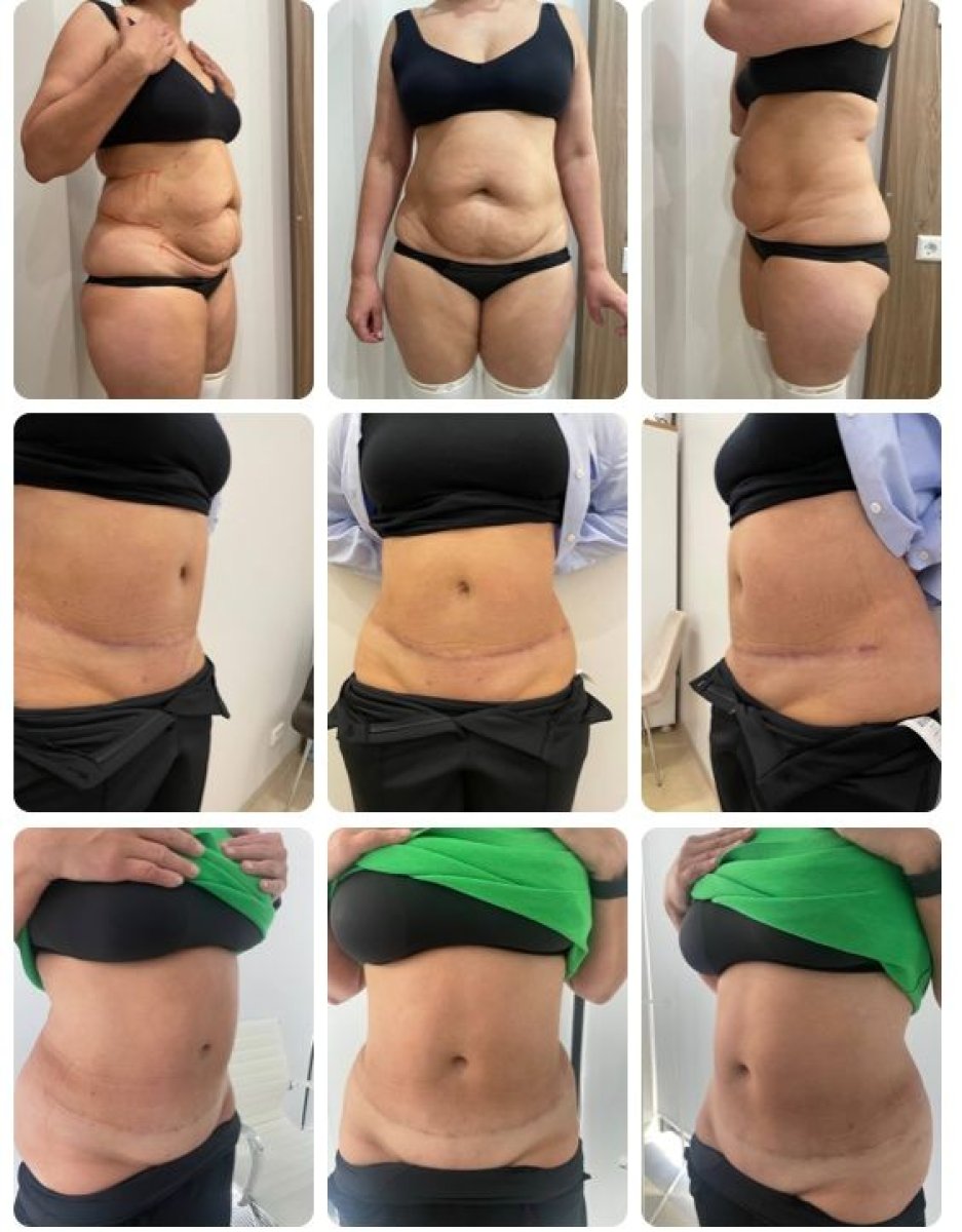 Vorher-nachher-Ergebnisse Bauchdeckenstraffung und Fettabsaugung bei Yurchenko Plastic Surgery Team Kyiv