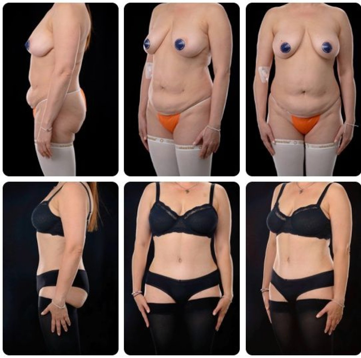 Результаты до и после абдоминопластики и липосакции в Yurchenko Plastic Surgery Team Kyiv