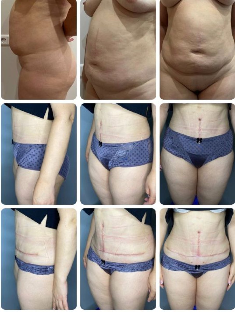 Vorher-nachher-Ergebnisse Bauchdeckenstraffung und Fettabsaugung bei Yurchenko Plastic Surgery Team Kyiv