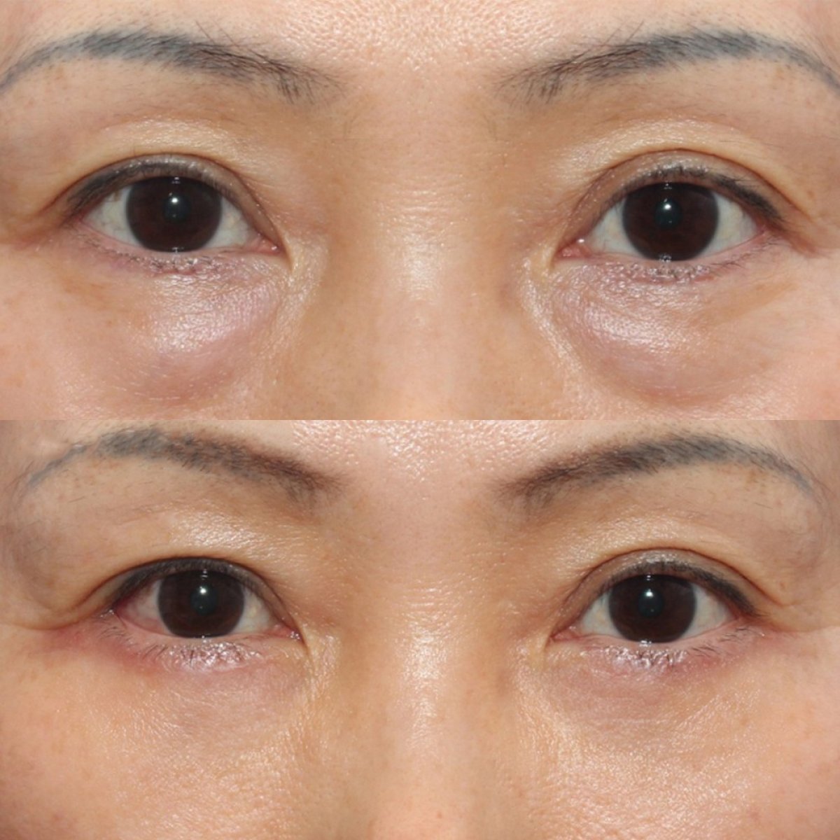 Результати нижньої блефаропластики повік до і після в HERSHE Plastic Surgery Korea