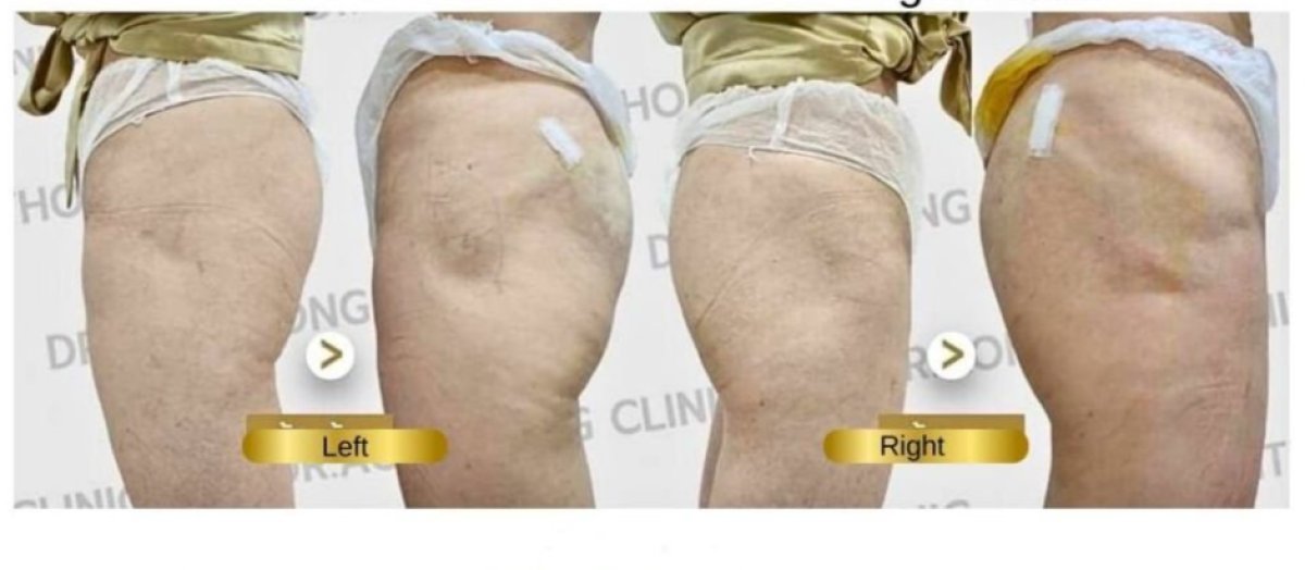 نتائج حقن الفيلر للفخذين قبل وبعد في Doctor Aomthong Clinic - Center For Women