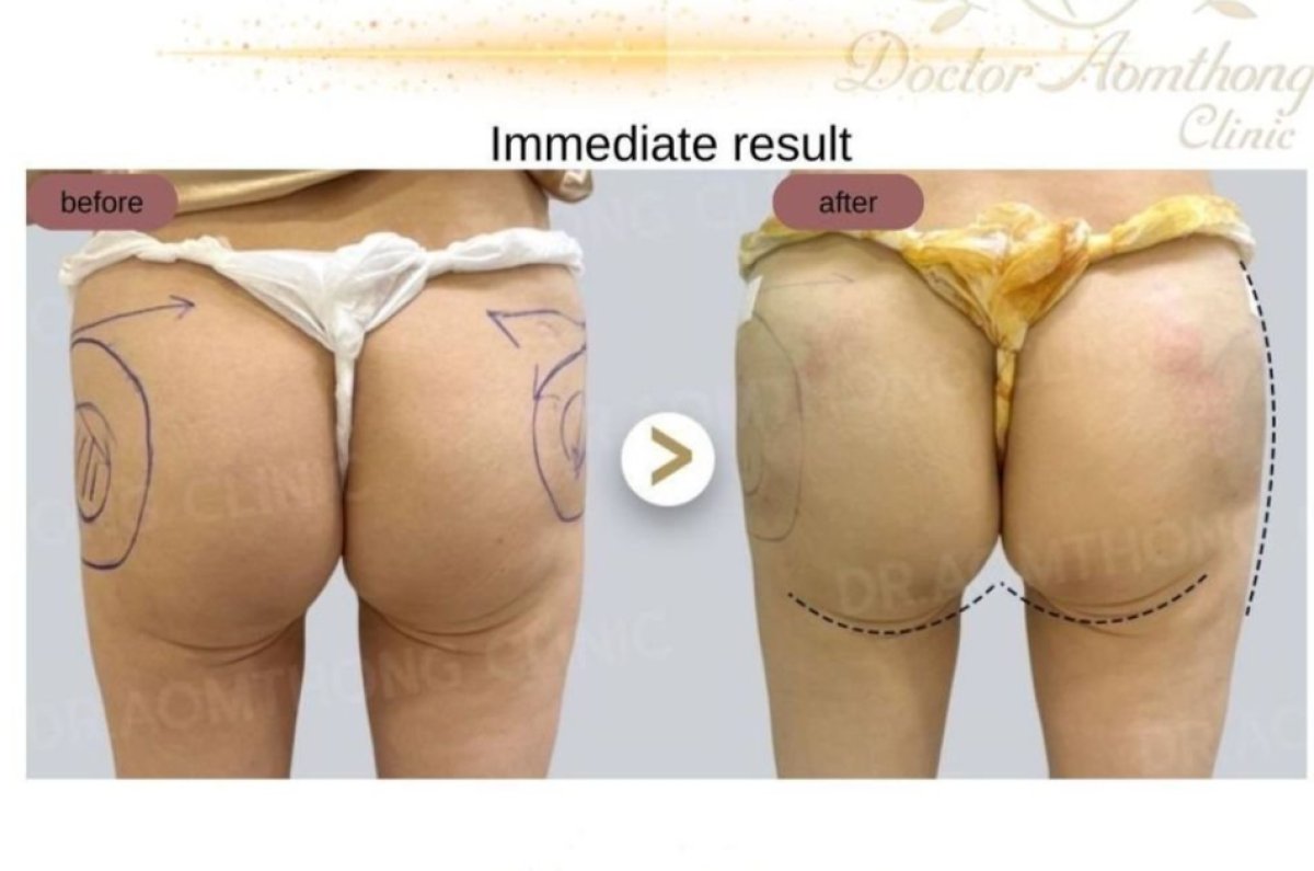 نتيجة حقن الفيلر للأرداف قبل وبعد في Doctor Aomthong Clinic - Center For Women