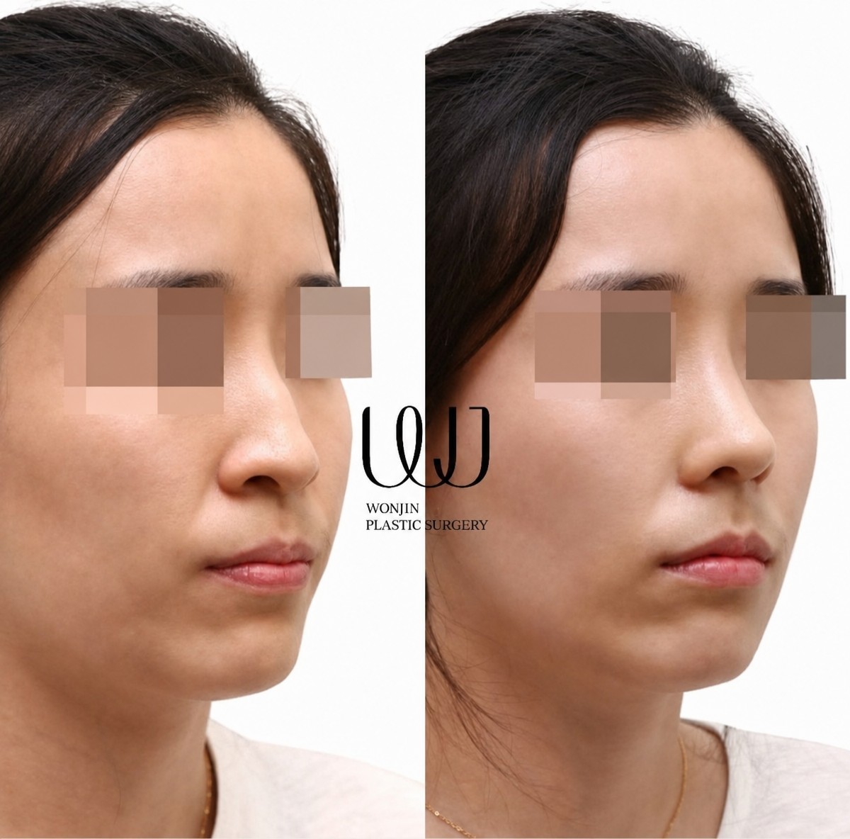 Resultados de rinoplastia antes y después en Wonjin Plastic Surgery Clinic, nariz mejorada