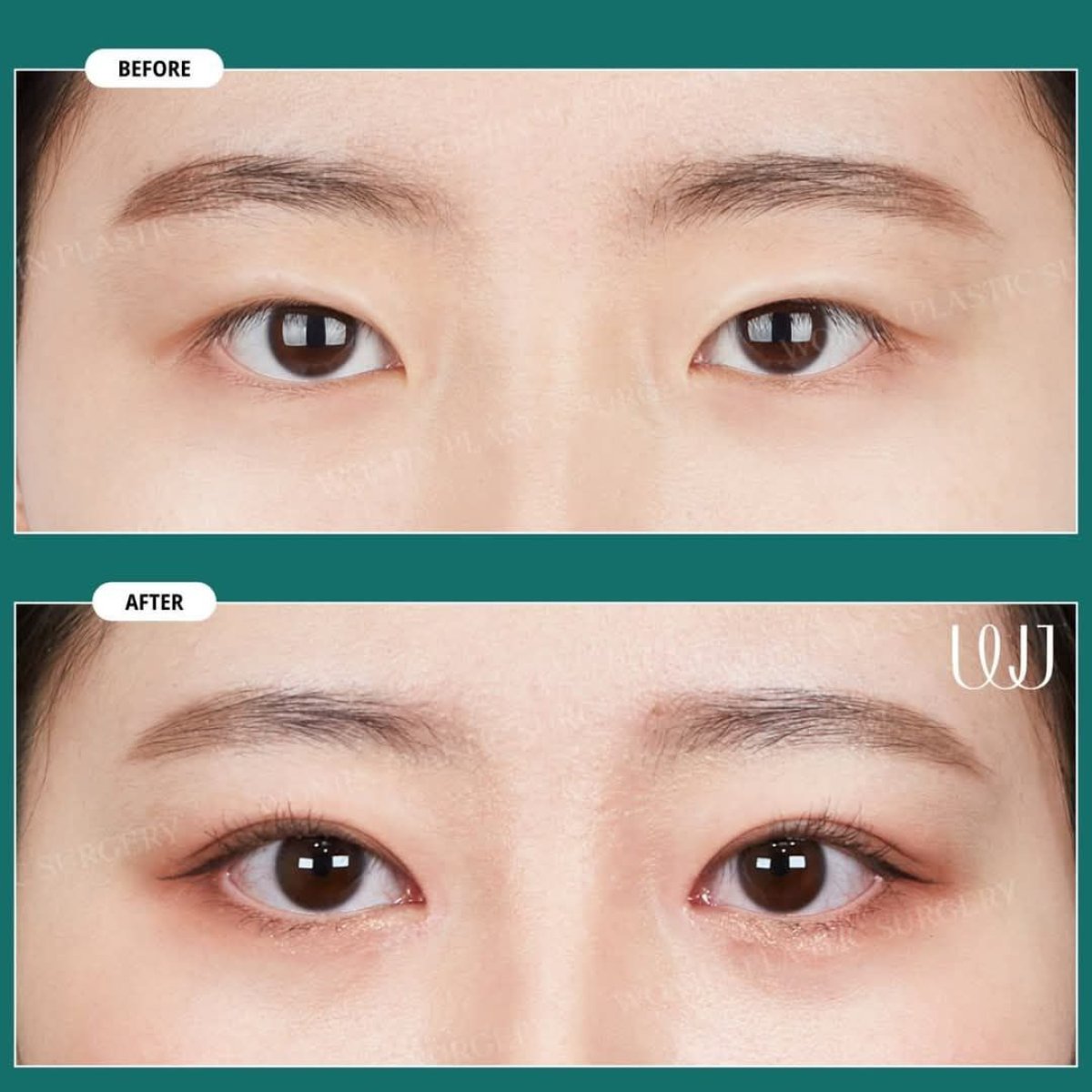 Before and after double eyelid surgery results at Wonjin Plastic Surgery Clinic, eye enhancement