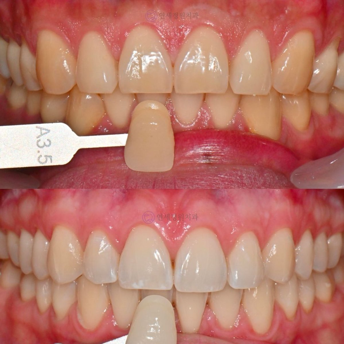 نتائج تبييض الأسنان قبل وبعد في عيادة Yonsei JW Dental Clinic، ابتسامة أكثر إشراقًا