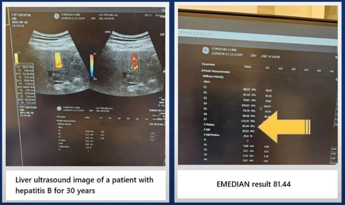 صورة موجات فوق صوتية للكبد ونتيجة EMEDIAN لمريض التهاب الكبد B في RE:YOUTH (YONSEI BH Arterial Stemcell Clinic)