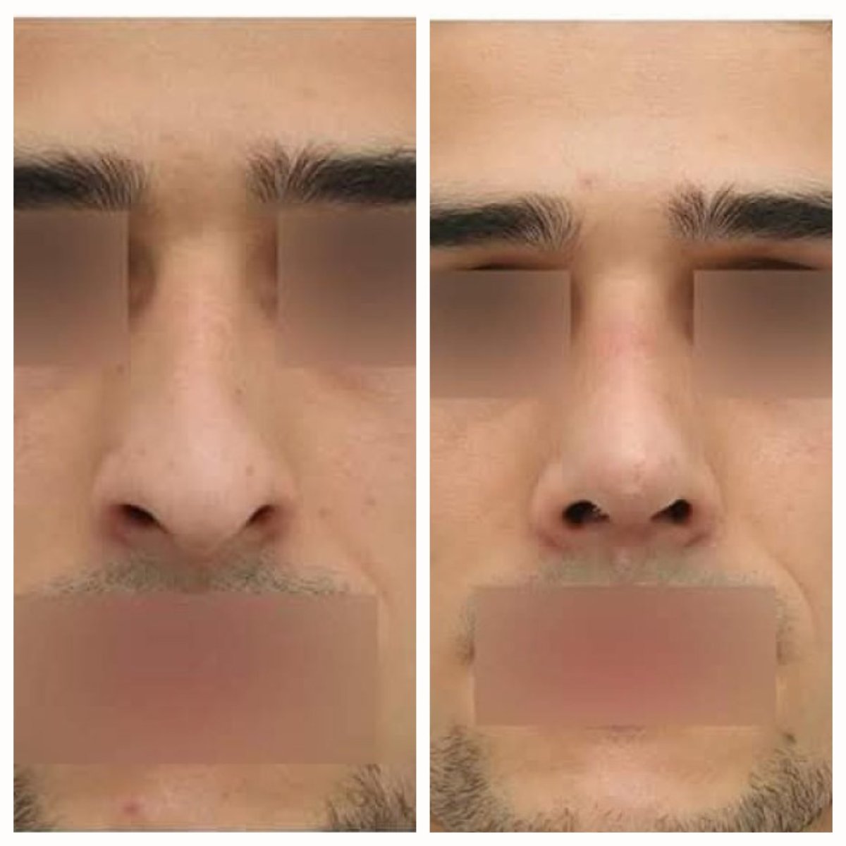 نتائج عملية تجميل الأنف قبل وبعد في عيادة وونجين، تحسين شكل الأنف