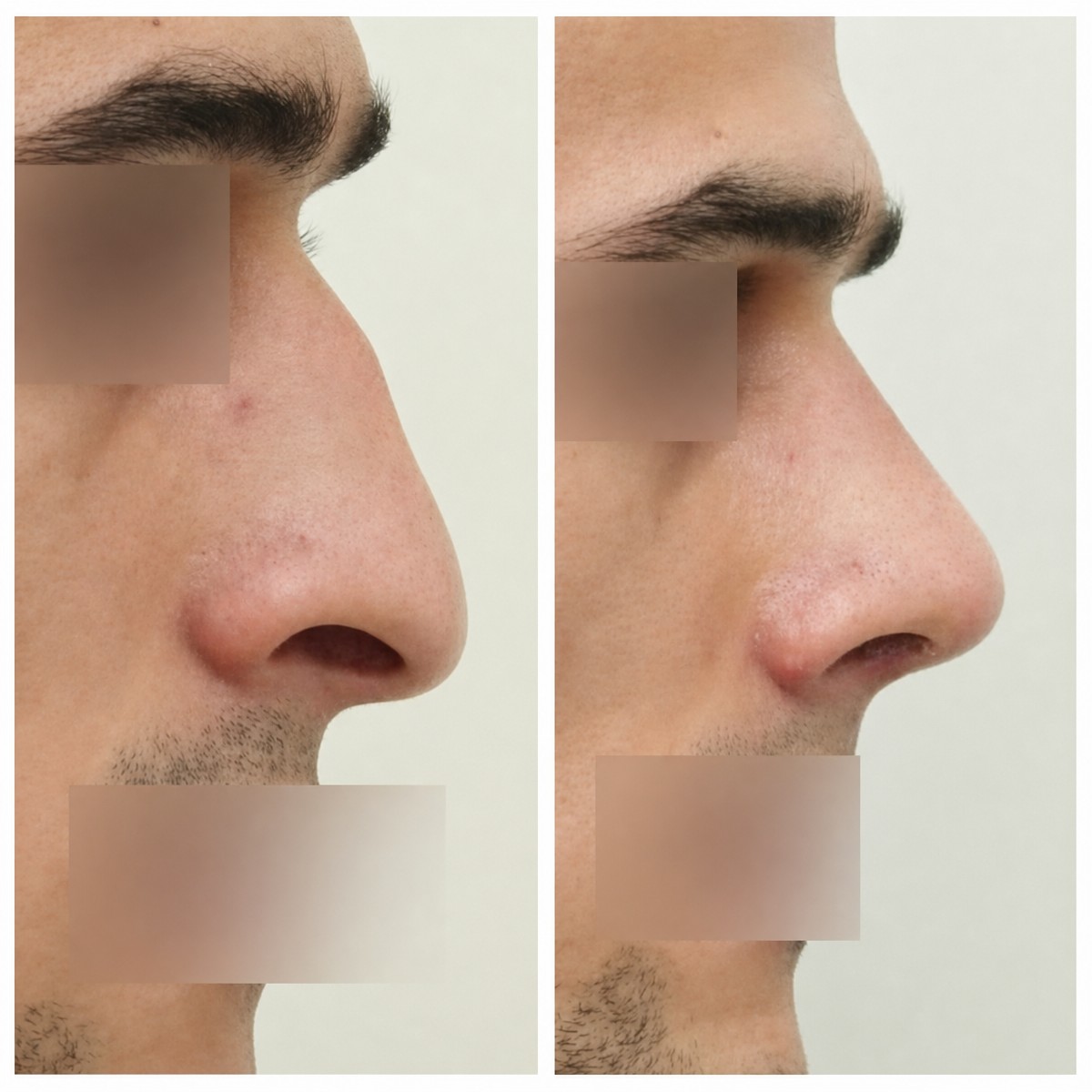 Before and after rhinoplasty results at Wonjin Plastic Surgery Clinic, improved nose profile