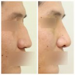 Before and after Rhinoplasty (nose job) photos by Dr. 