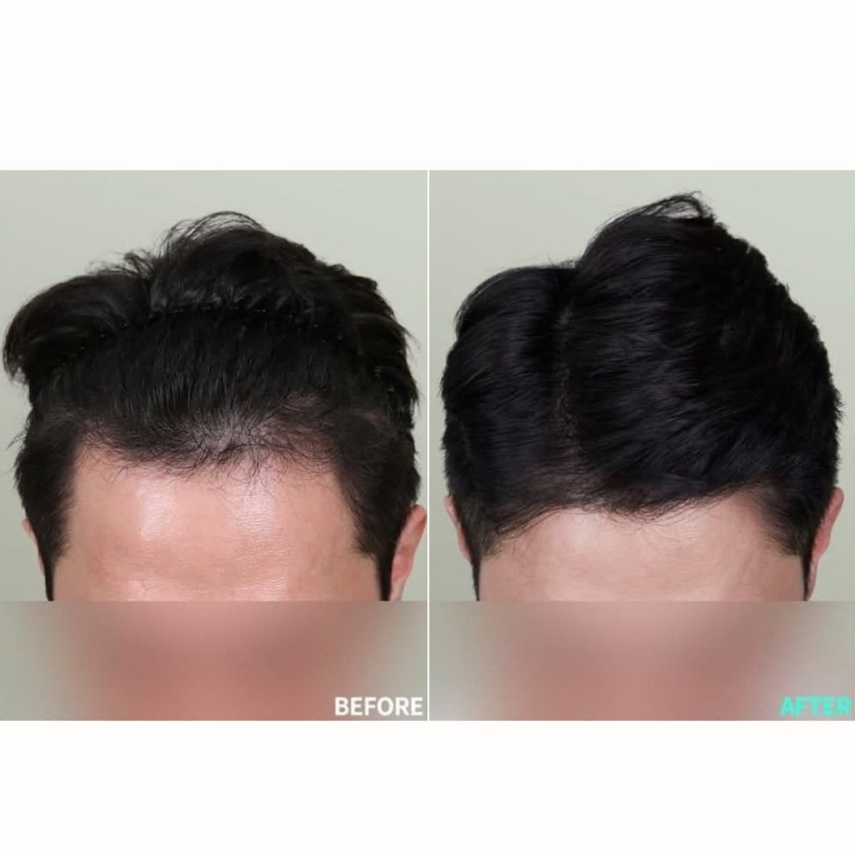Résultats greffe de cheveux avant-après à la clinique Wonjin, ligne capillaire améliorée