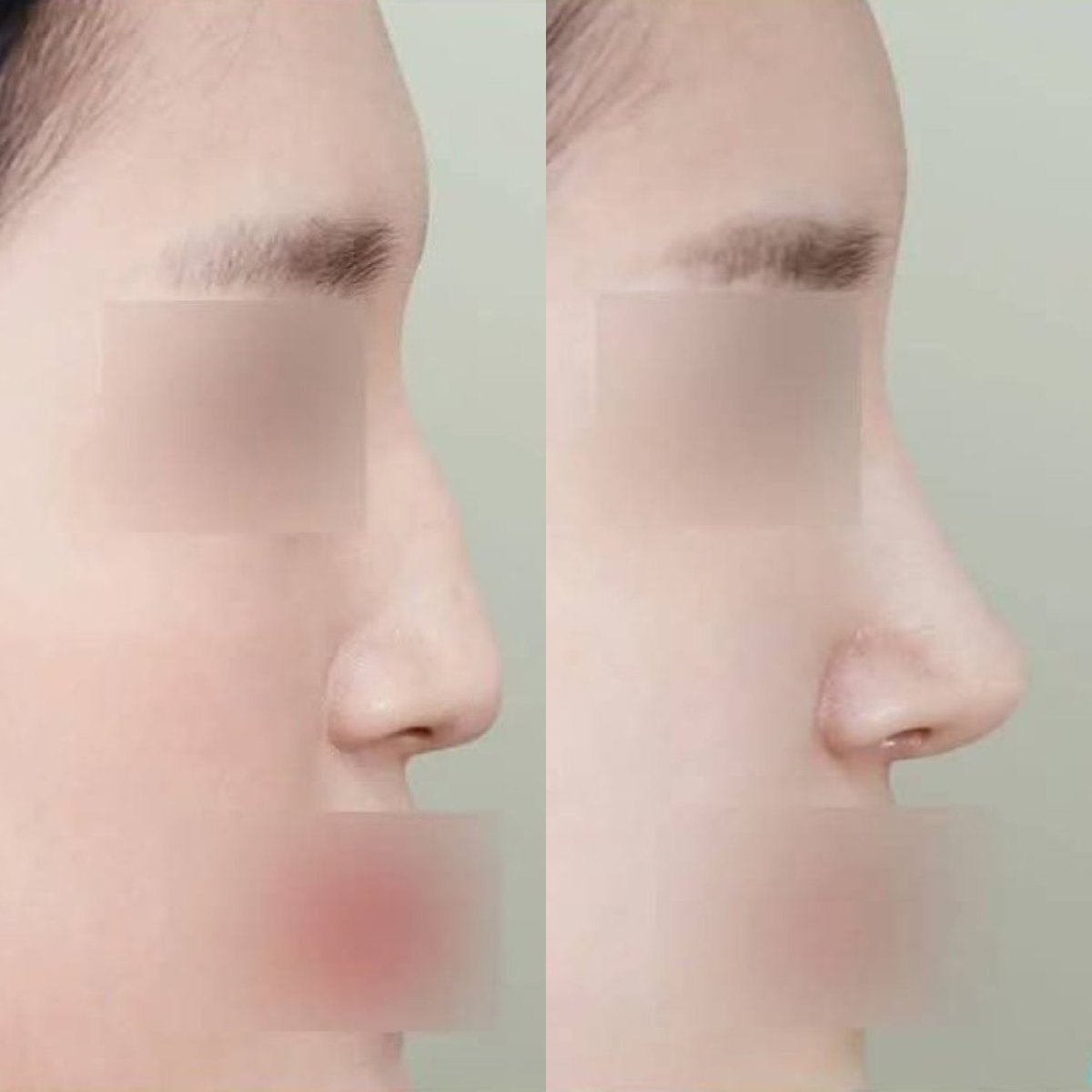 Before and after rhinoplasty results at Wonjin Plastic Surgery Clinic, nose reshaping outcome