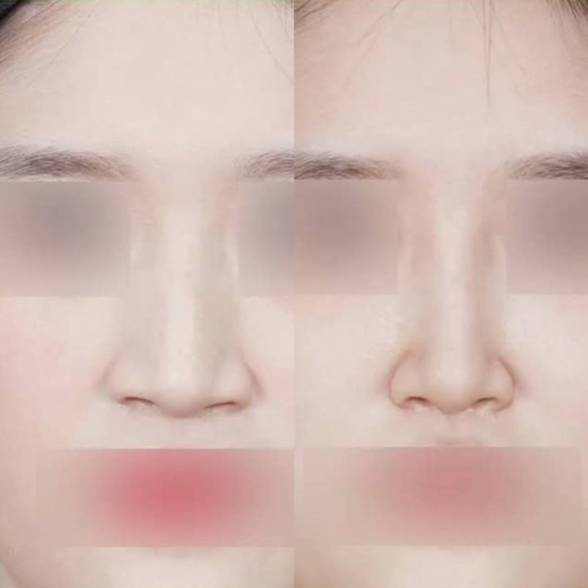 نتائج عملية تجميل الأنف قبل وبعد في عيادة وونجين، تحسين شكل الأنف