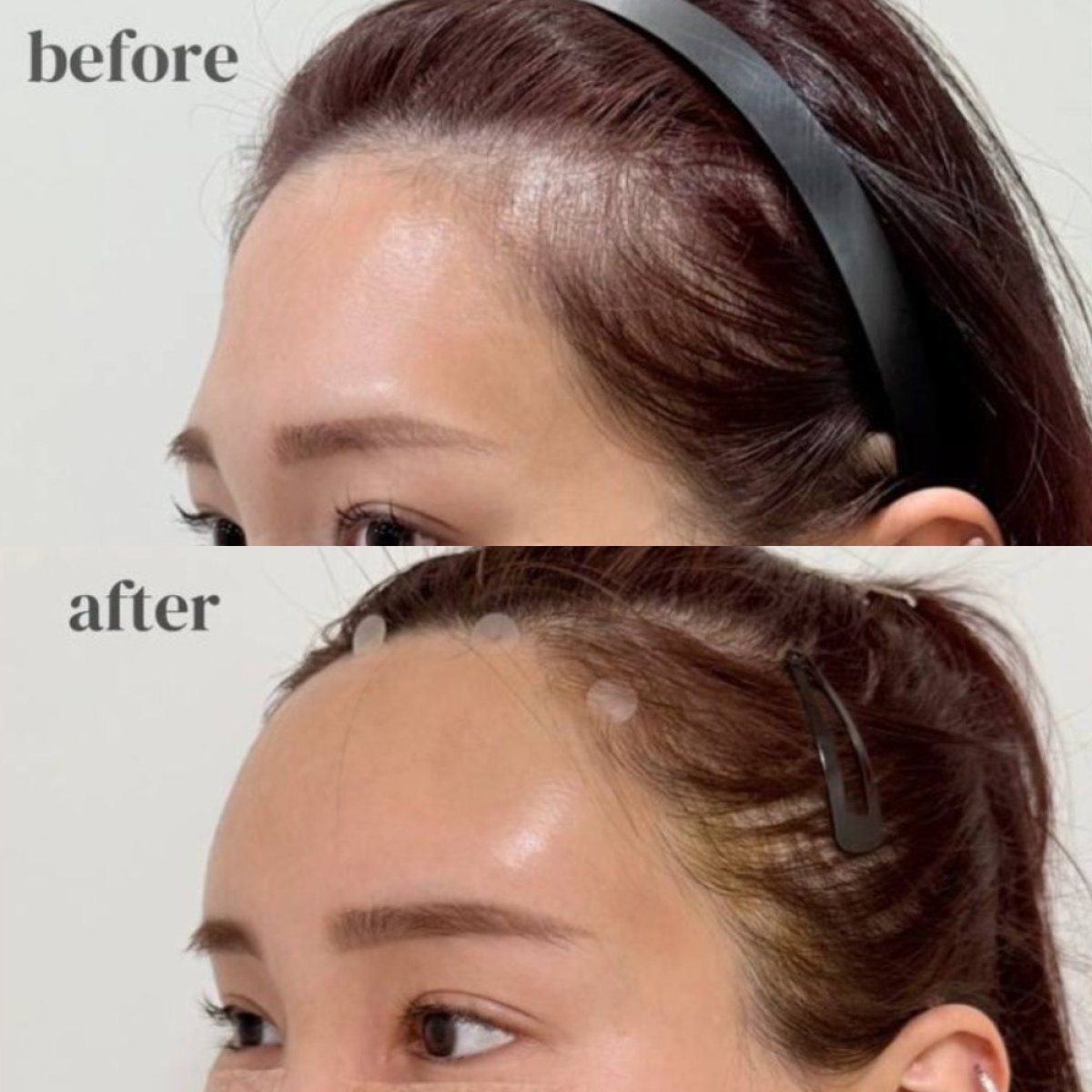 Efekty lipofillingu czoła przed i po w Wonjin Plastic Surgery Clinic, widoczny rezultat