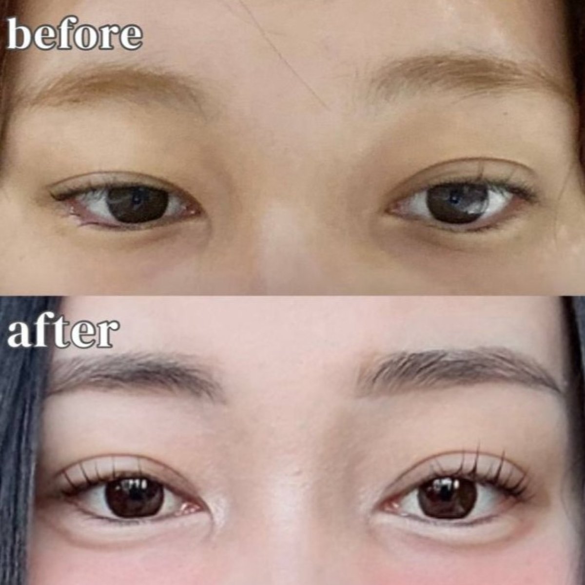نتائج عملية تجميل الجفون قبل وبعد في عيادة وونجين لجراحة التجميل، تصحيح الجفون