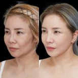 Before and after Facelift photos by Dr. Lee Hyuck Jae
