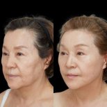 Before and after Facelift photos by Dr. Lee Hyuck Jae