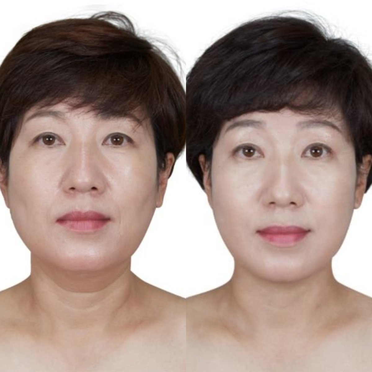 Resultados de lifting facial antes y después en Wonjin Plastic Surgery Clinic, rejuvenecimiento visible