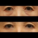 Before and after Blepharoplasty (Eyelid correction) photos by Dr. Kim Joo Bong 