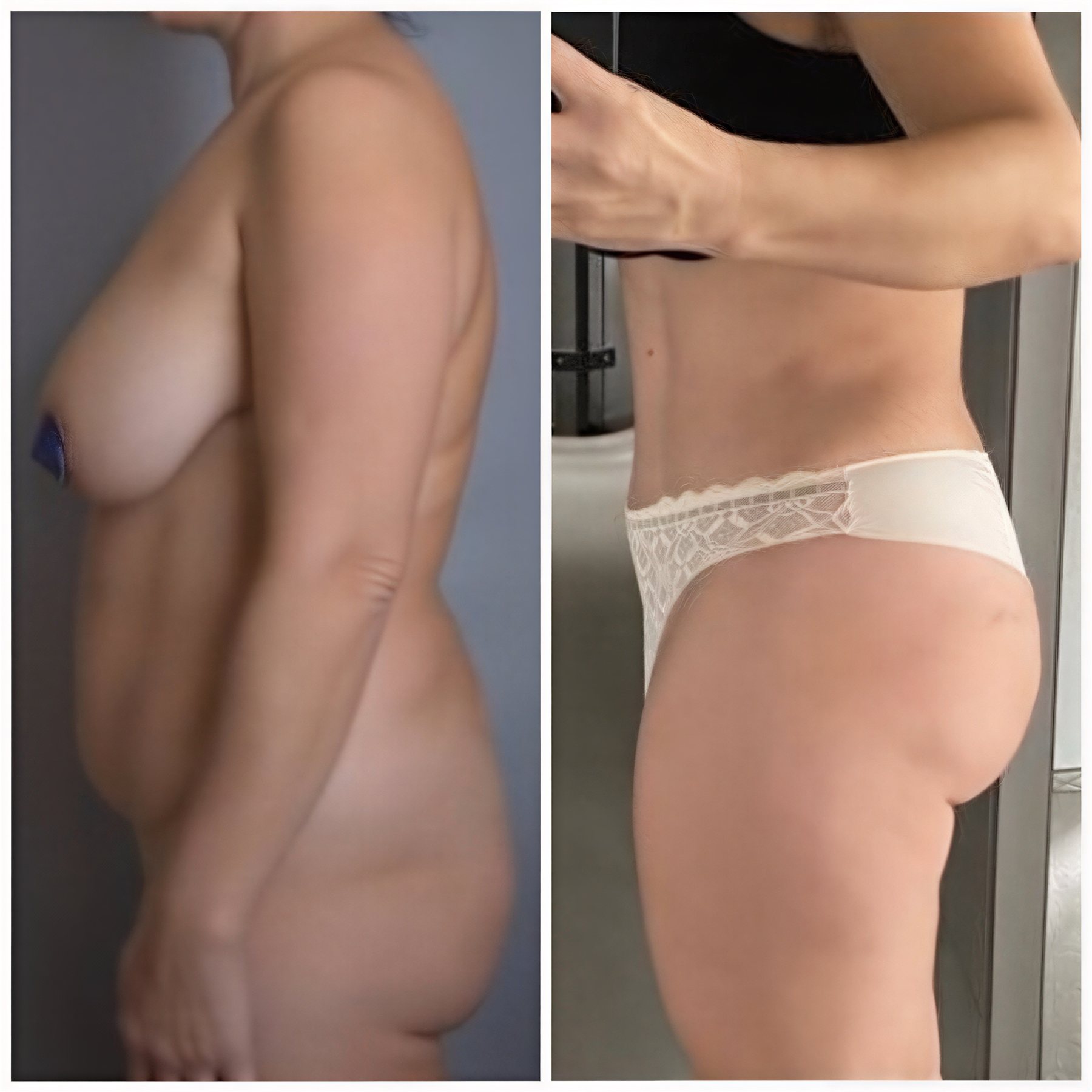 Resultados antes y después de abdominoplastia y liposucción en Yurchenko Plastic Surgery Team Kyiv