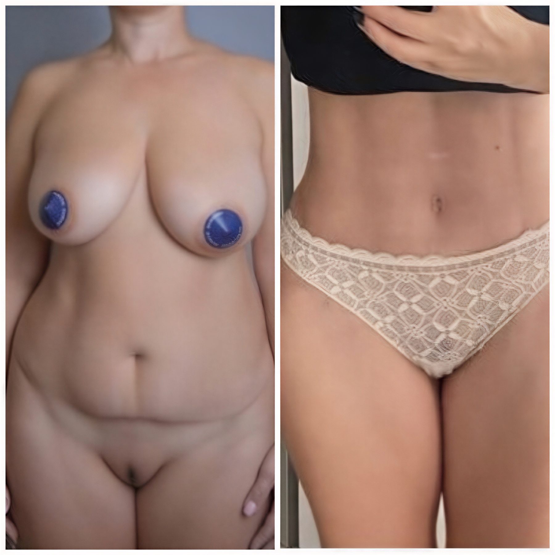 Resultados de abdominoplastia y liposucción antes y después en Yurchenko Plastic Surgery Team Kyiv