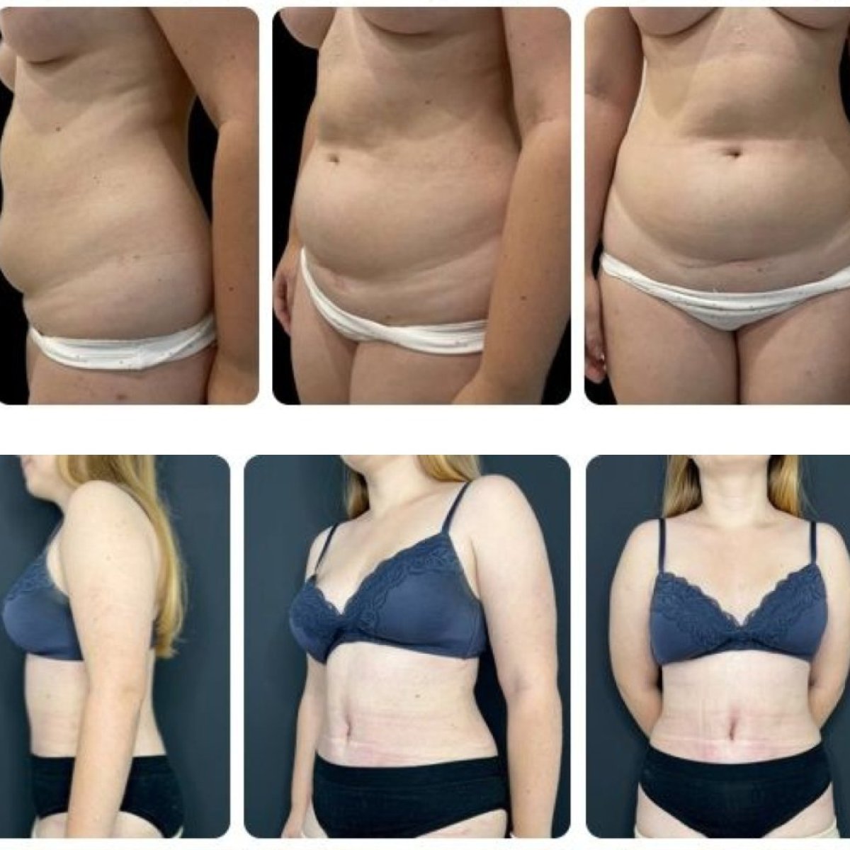 Результаты до и после абдоминопластики и липосакции в Yurchenko Plastic Surgery Team Kyiv