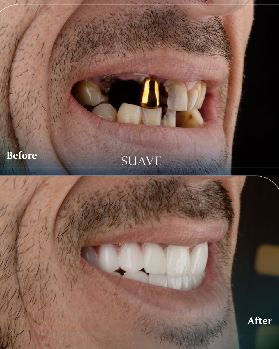 Résultats avant et après couronnes dentaires à SUAVE DENTAL CLINIC, sourire restauré