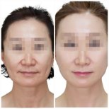 Before and after Facelift photos by Dr. Lee Hyuck Jae