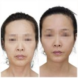 Before and after Facelift photos by Dr. Lee Hyuck Jae