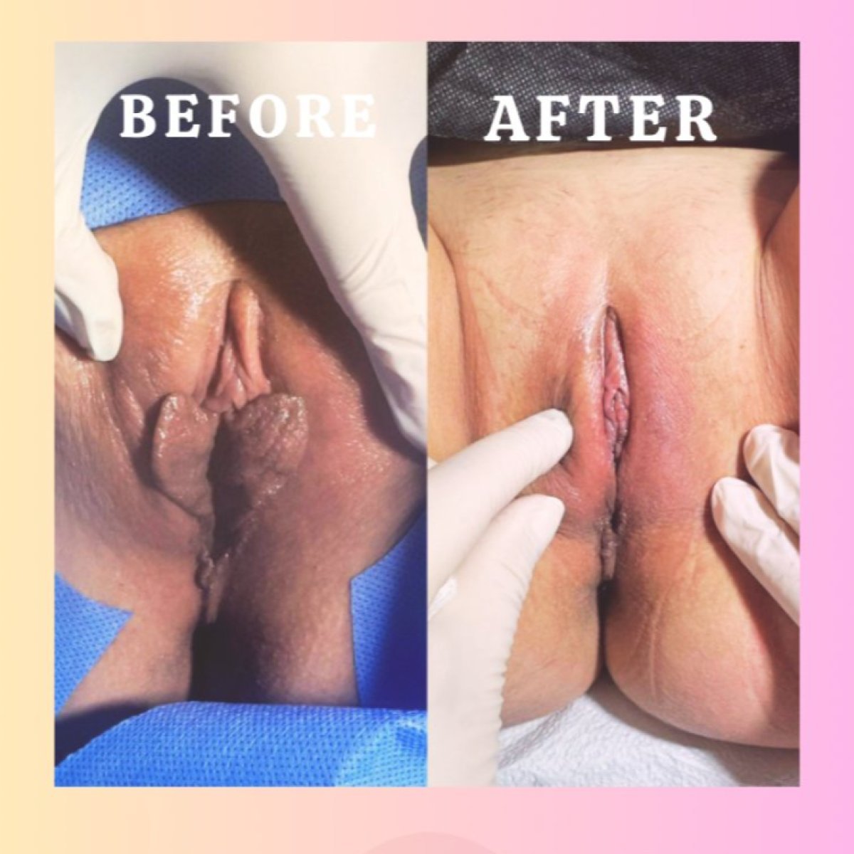 Before and after clitoroplasty results at Dr. İrem Yengel Clinic, visible genital refinement