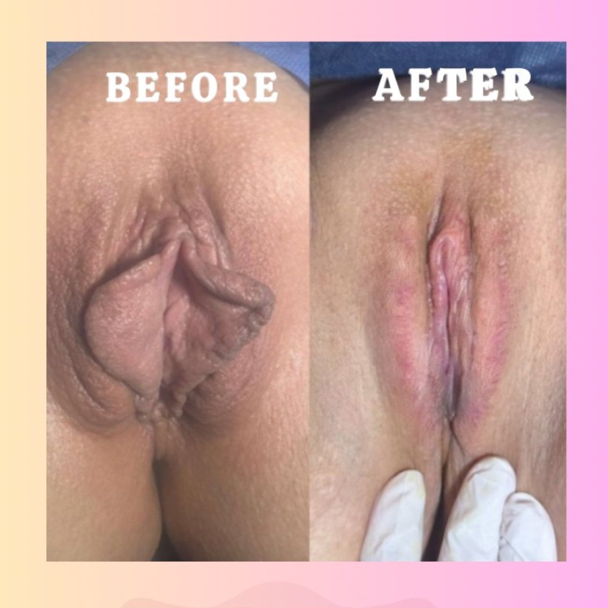 Before and after vaginoplasty results at Dr. İrem Yengel Clinic, improved vaginal appearance