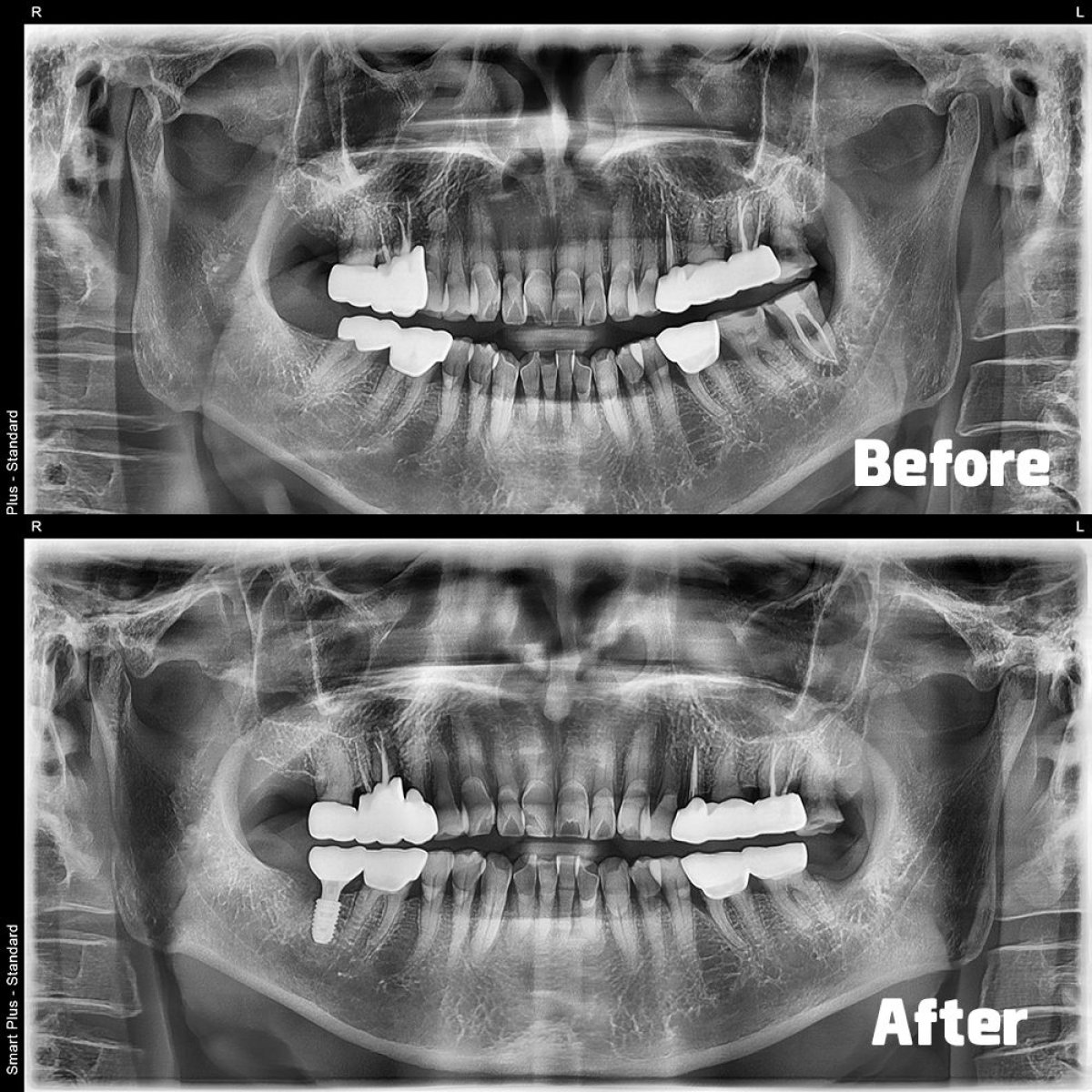 Результаты до и после имплантации зубов в Yonsei JW Dental Clinic, восстановление челюсти