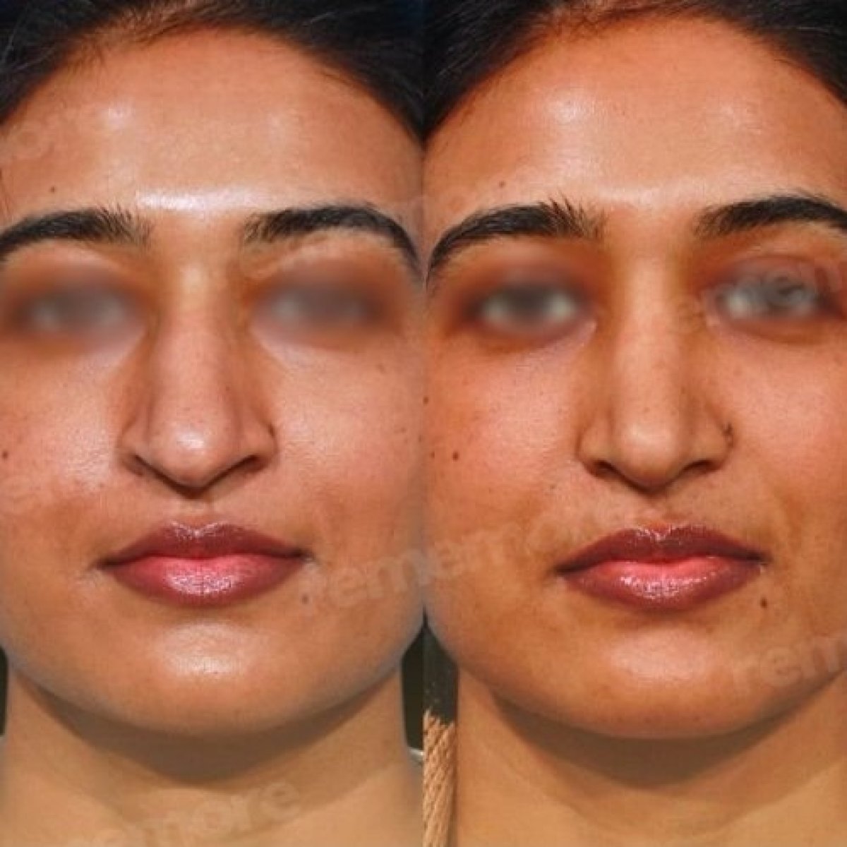 Resultados de cirugía de feminización facial antes y después en Memorial Bahçelievler Hospital