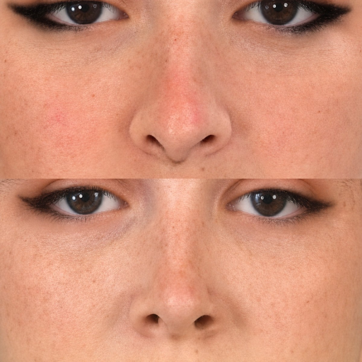 Resultados de feminización facial antes y después en Memorial Bahçelievler Hospital, remodelación nasal