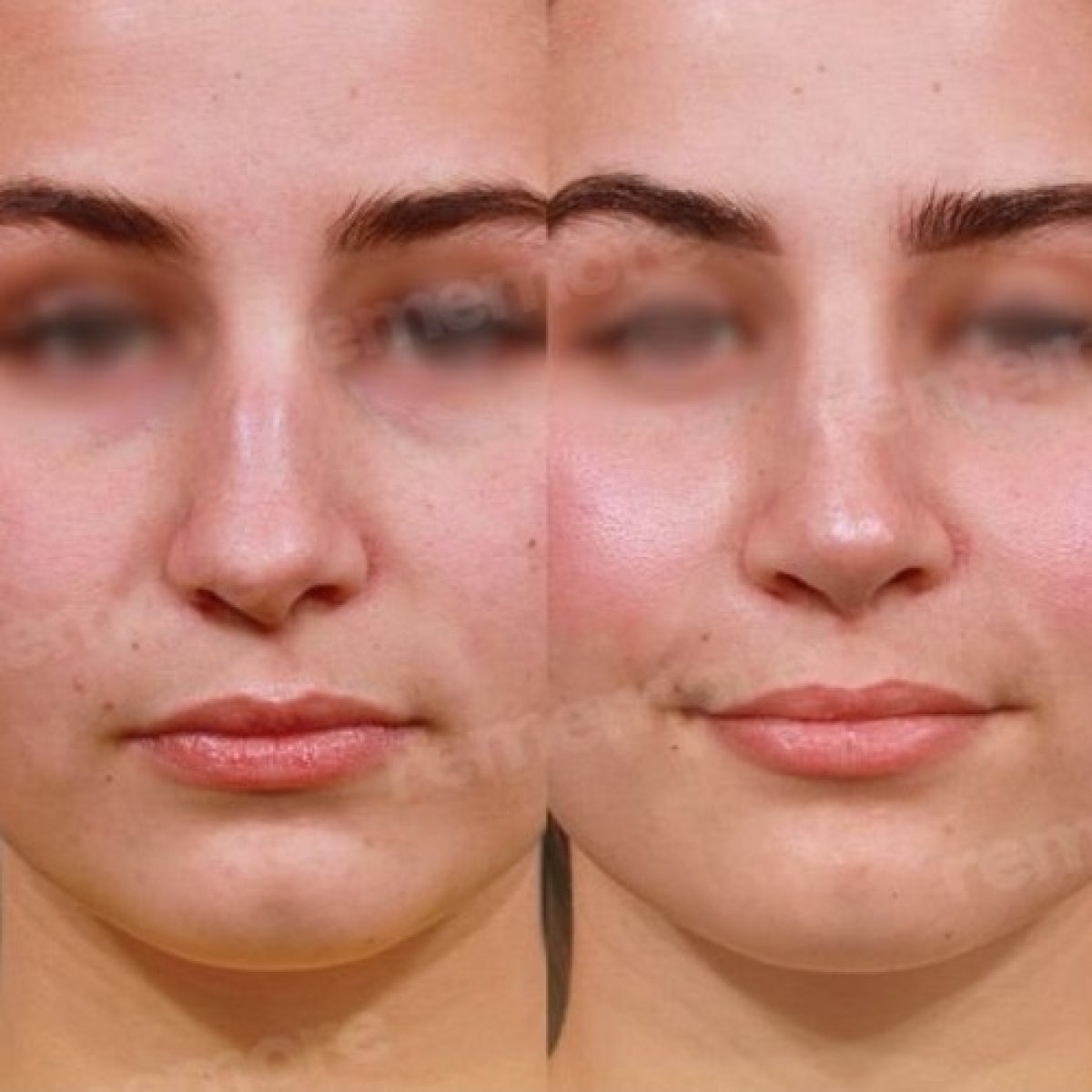 Resultados de cirugía de feminización facial antes y después en Memorial Bahçelievler Hospital