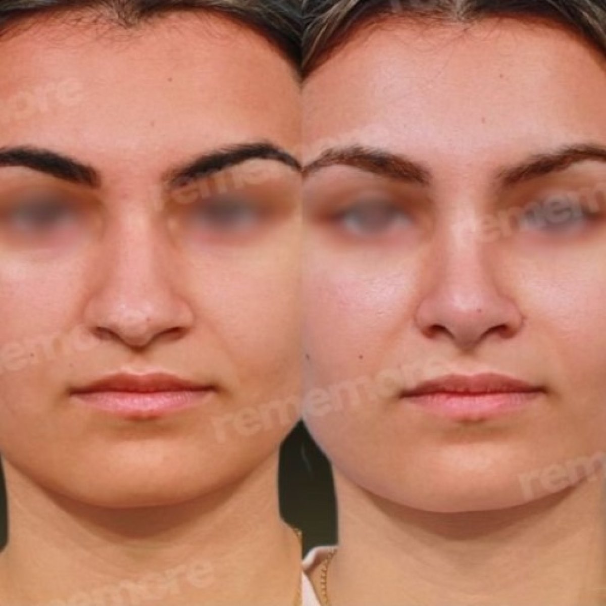 Resultados de feminización facial antes y después en Memorial Bahçelievler Hospital